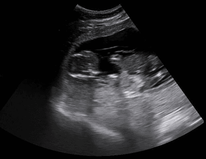 Ultrasound